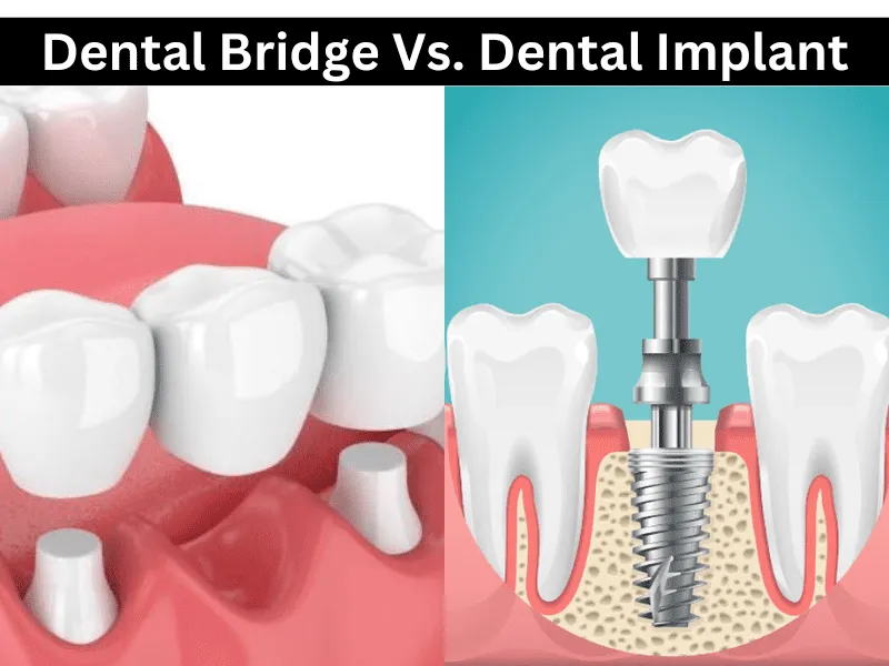 تفاوت ایمپلنت با روش های دیگر- بهترین مرکز ایمپلنت در کرج