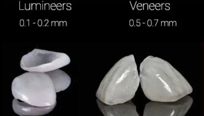 مقایسه جنس روکش لیمینت و لومینرز