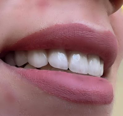 لمینت دندان در کرج