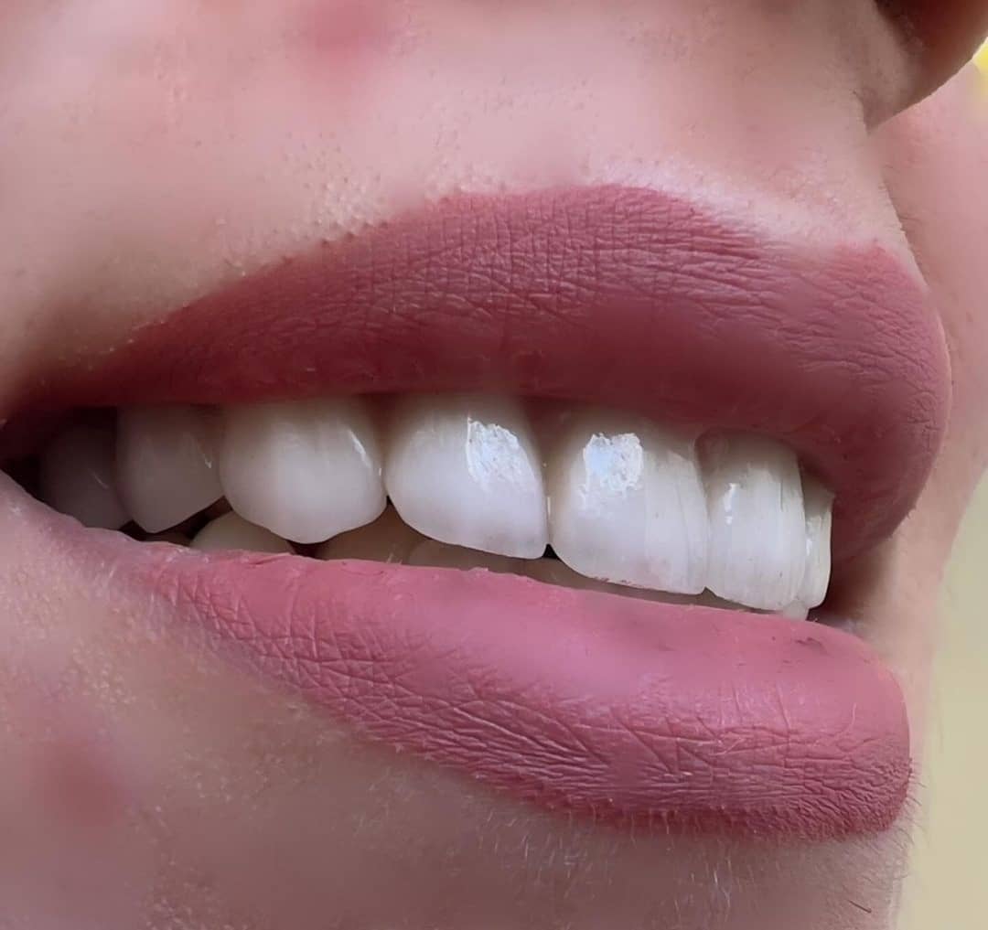 لمینت دندان در کرج