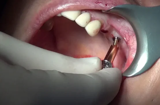 ایمپلنت دندان در کرج