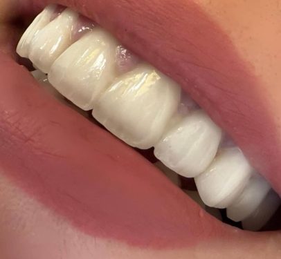 معایب لمینت دندان