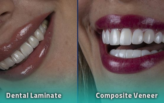 مقایسه لمینت و کامپوزیت