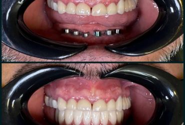ایمپلنت دیجیتال - قبل و بعد