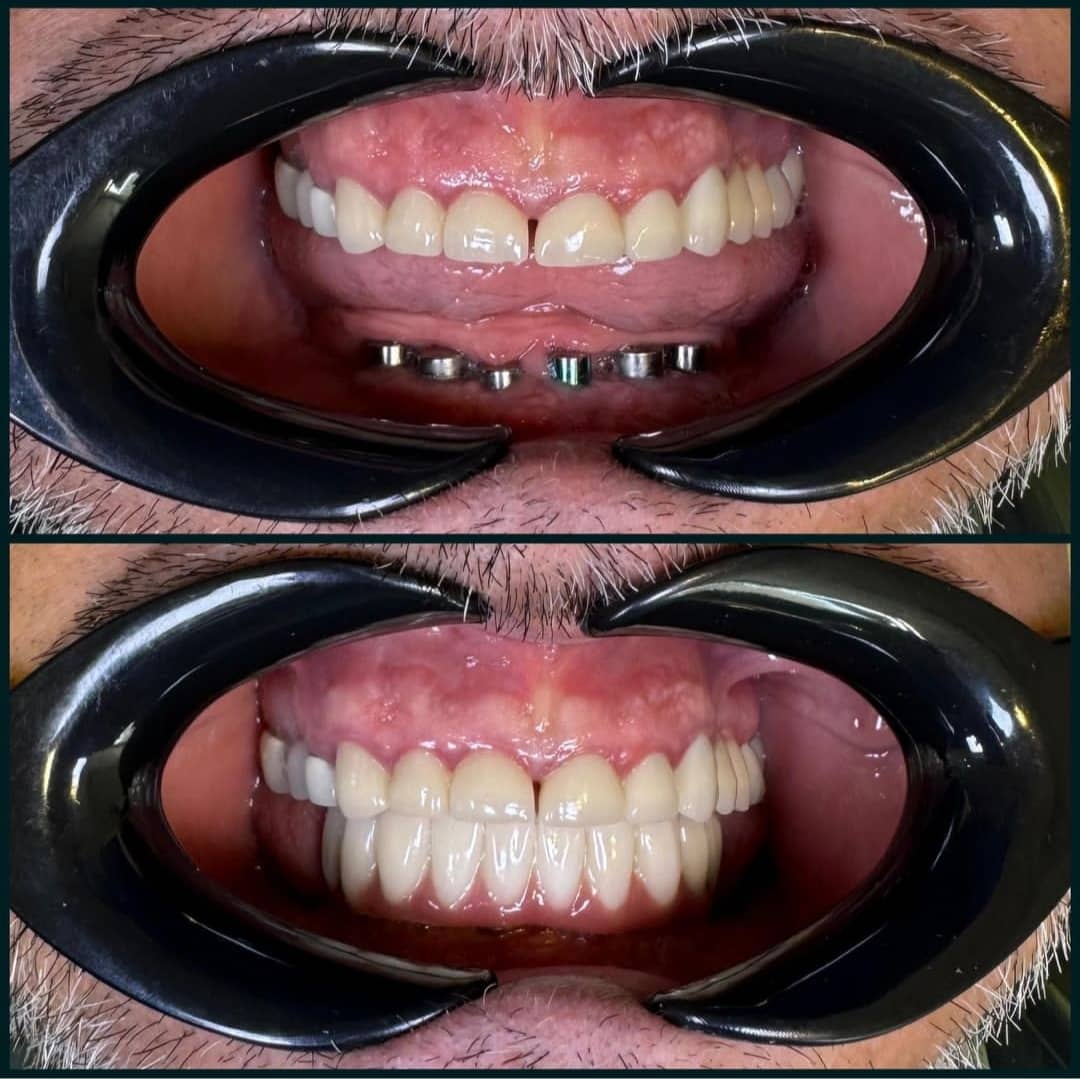 ایمپلنت دیجیتال - قبل و بعد