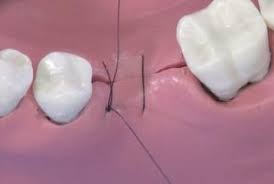 تصویر بخیه ایمپلنت