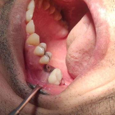 ایمپلنت دندان، پایه ایمپلنت