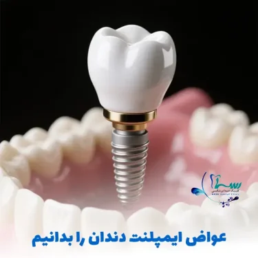 عوارض ایمپلنت دندان - تصویر ایمپلنت دندان