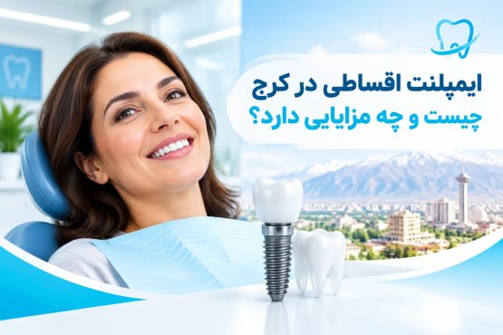 ایمپلنت اقساطی در کرج چیست و چه مزایایی دارد؟