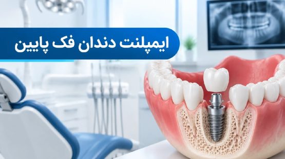 ایمپلنت دندان فک پایین