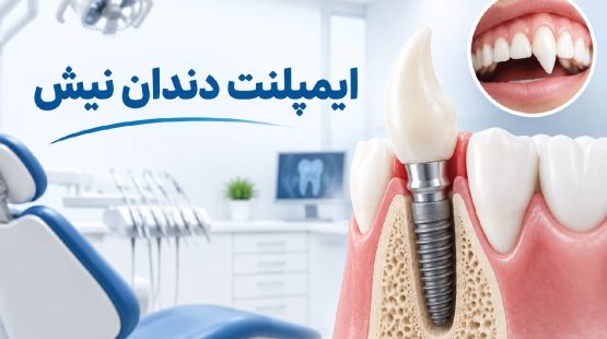 ایمپلنت دندان نیش