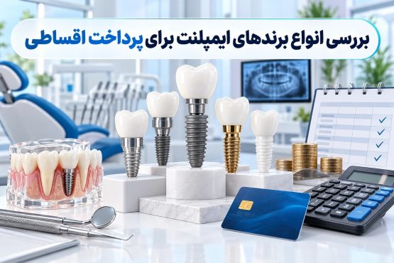 بررسی انواع برندهای ایمپلنت برای پرداخت اقساطی