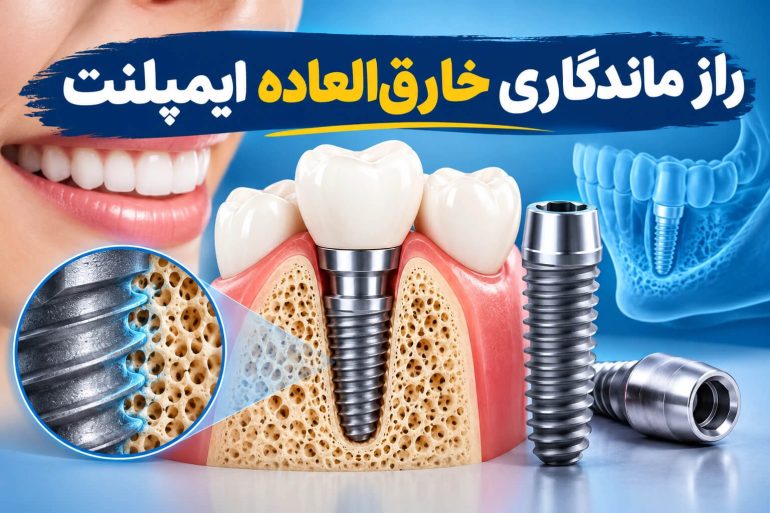 راز ماندگاری خارق_العاده ایمپلنت (1)