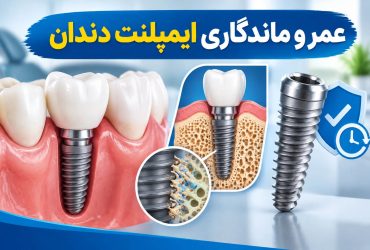 عمر و ماندگاری ایمپلنت دندان (1)