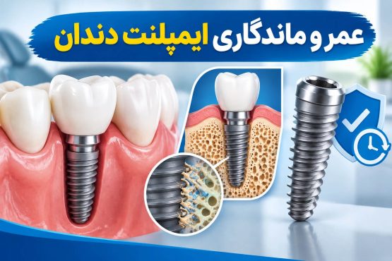 عمر و ماندگاری ایمپلنت دندان (1)
