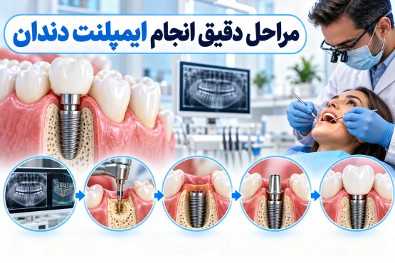 مراحل دقیق انجام ایمپلنت دندان (پروسه درمانی)
